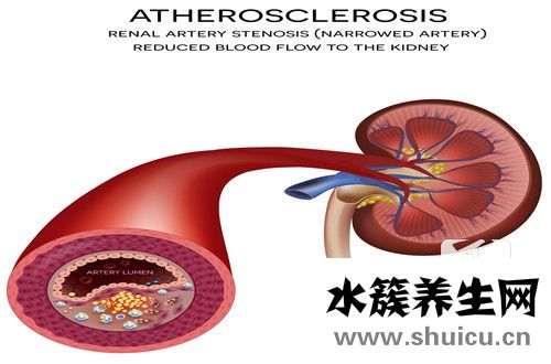 外周動(dòng)脈疾病