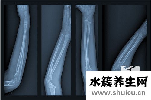 骨髓增殖性疾病