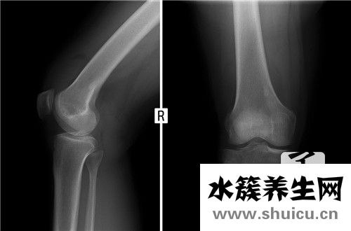 股骨頸骨折治療