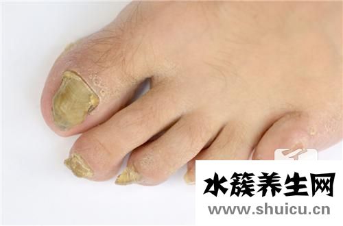 醋精可以治灰指甲嗎