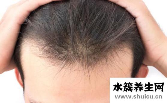 頭發禿頂怎么治療