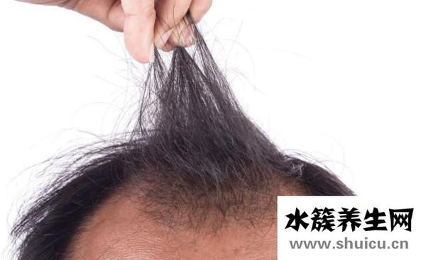 頭發禿頂怎么治療