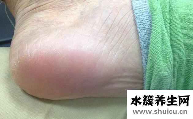 腳后跟疼