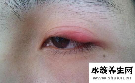 上眼皮腫是什么原因