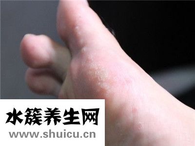 腳氣產(chǎn)生的原因