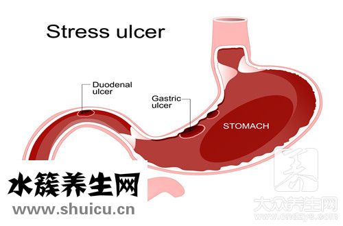 十二指腸間質(zhì)瘤