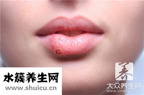 唇炎能徹底治好嗎