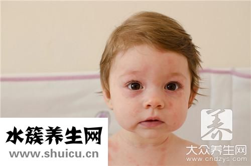 眼瞼神經(jīng)性皮炎