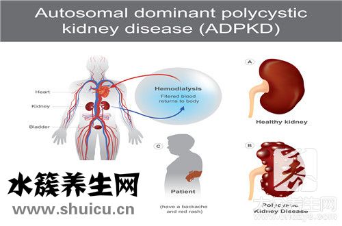 巧克力囊腫復發
