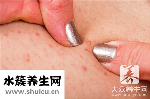 毛囊炎用什么藥膏