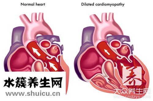 二尖瓣手術(shù)