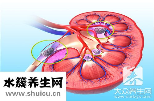 腎結石是什么引起