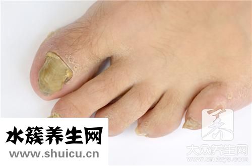 指甲營養(yǎng)不良