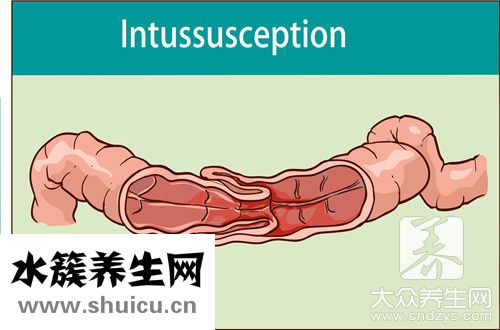 巨結(jié)腸癥狀