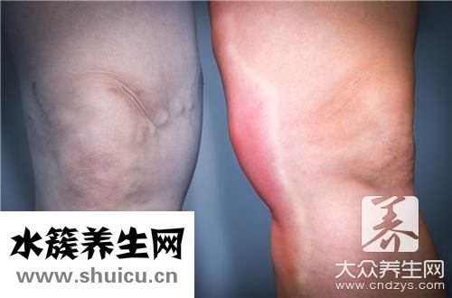 消除水腫最快方法