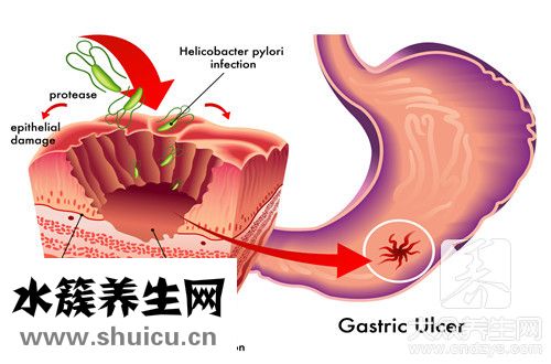 淺表性胃炎伴膽汁反流