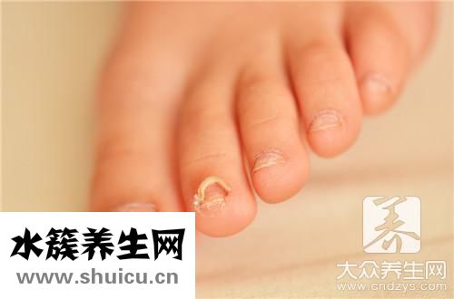 灰指甲外用藥最有效