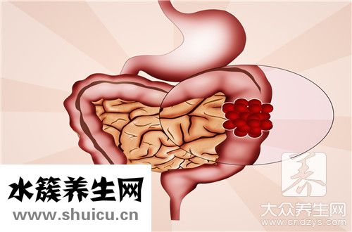 潰瘍結腸炎