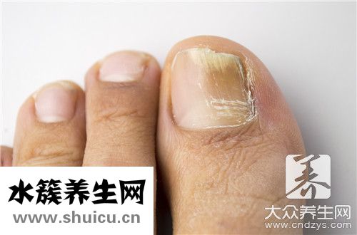 灰指甲外用藥最有效