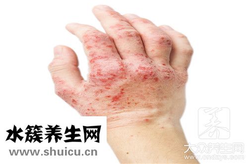 長濕疹是身體排毒表現