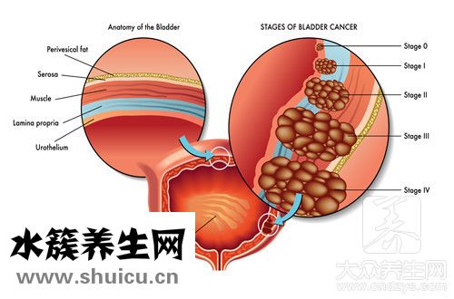 導(dǎo)管內(nèi)癌