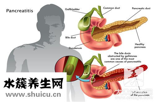 膽固醇高有什么癥狀