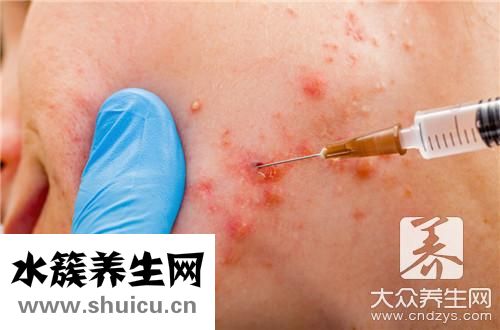 擠痘引發(fā)腦膜炎