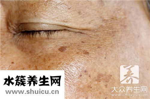 尖銳疣會自己消失