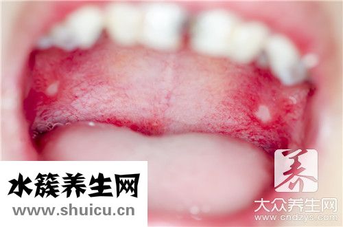 口腔上顎像破皮一樣疼