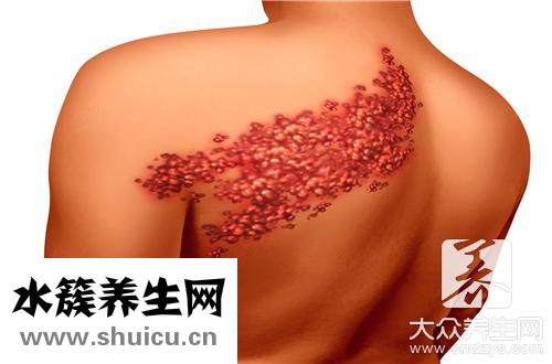 皰疹是啥病