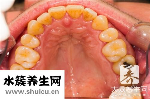 楔狀缺損不要盲目補牙