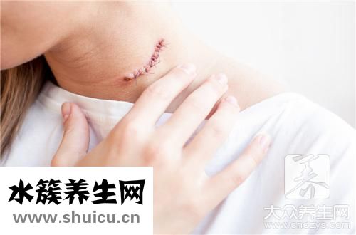 縱隔淋巴結鈣化