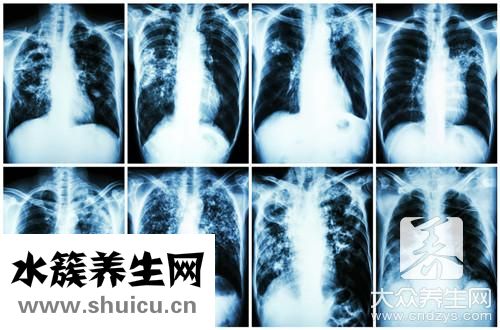 肺纖維化是回事