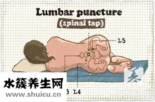格林巴利后遺癥