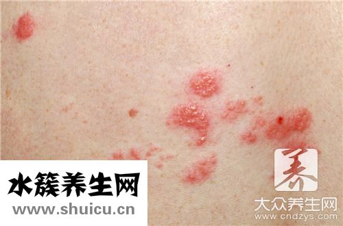 病毒性疹子癥狀