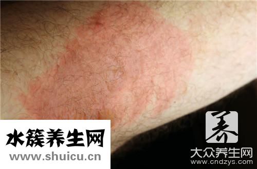 紫癜會(huì)癢嗎