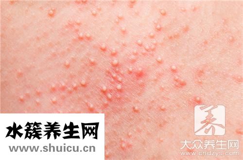 身上長大紅疙瘩硬硬