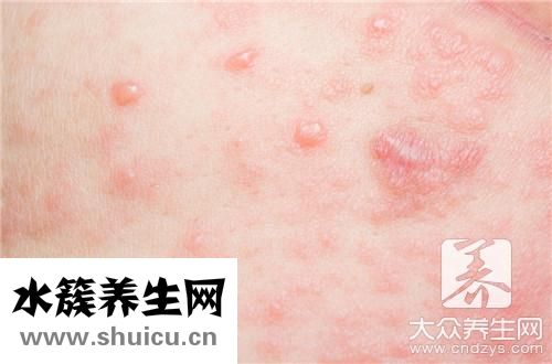 身上長大紅疙瘩硬硬