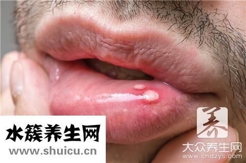 嘴角瘡