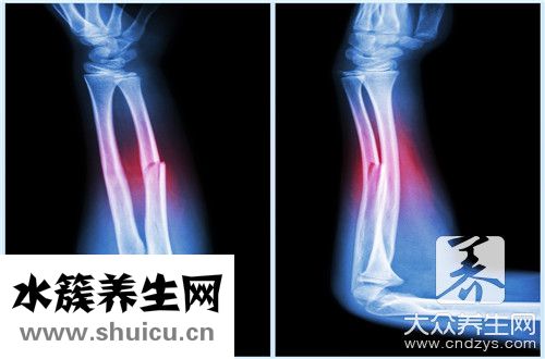 骨折過早走路危害