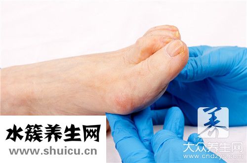 腳后跟發麻