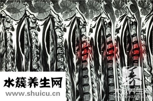 頸椎病會引起胸痛嗎