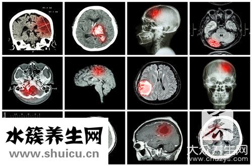 腦積水有哪些癥狀