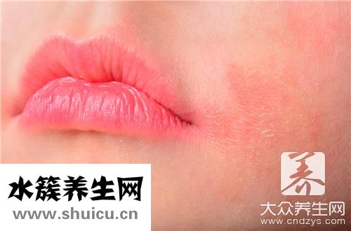 激素性皮炎能自愈嗎