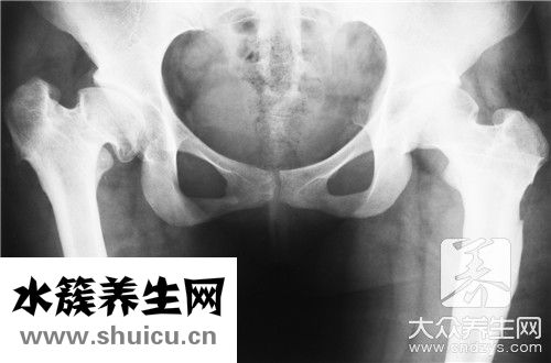 電刺激盆底肌治療危害