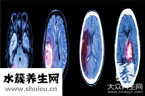 腦子長(zhǎng)瘤自己判斷