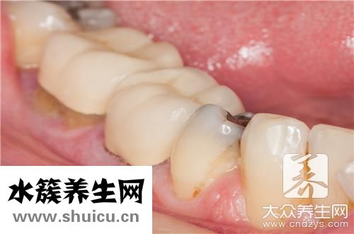 去除牙齒上煙垢