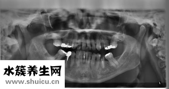 夢見掉了一顆牙齒