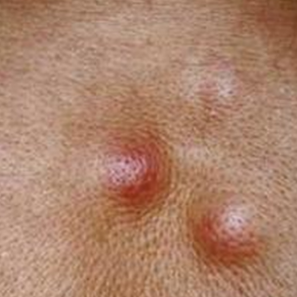 癌癥早期癥狀可能不明顯但隨病情進展可加重