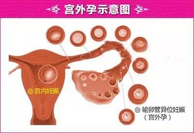 宮外孕最明顯的征兆,宮外孕最明顯的征兆hcg